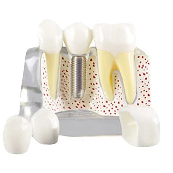 Dantų demonstravimo modelio implanto nuimamas analizės vainiko tiltas -paciento bendravimui